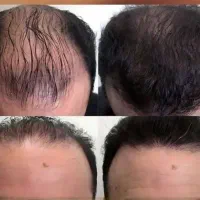 دیگه بخاطر کچلی کلاه نزار