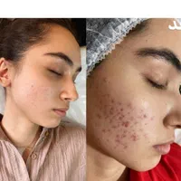 فشیال پاکسازی لیزر پوست جوانساز|خدمات آرایشگری و زیبایی|شیراز, معالی‌آباد|دیوار