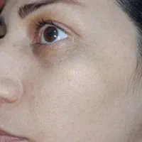 درمان تخصصی لک و فیشال کلینیک تخصصی کمیل|خدمات آرایشگری و زیبایی|اهواز, زیتون کارمندی|دیوار