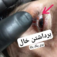 برداستن خال ، ختنه، زگیل،میخچه، جراحی سرپایی درمطب|خدمات آرایشگری و زیبایی|تویسرکان, |دیوار
