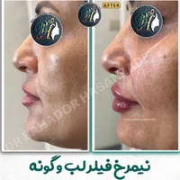 فیلر(ژل) لب گونه چانه خط خنده زاویه توسط پزشک رشت|خدمات آرایشگری و زیبایی|رشت, گلسار|دیوار