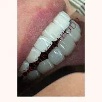 کامپوزیت لب شیشه‌ای با تخفیف محدود و ویزیت رایگان