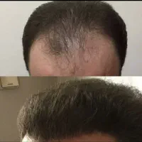 کاشت مووابروشیرازی حرفه ای شروع از۲۰تومن|خدمات زیبایی و سلامت|تهران, صد دستگاه|دیوار
