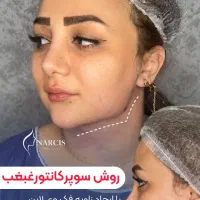 لیپو غبغب/وی لاین/بوکالفت/بلفاروپلاستی