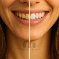 جرمگیری و بلیچینگ دندان / دندانپزشکی VIP