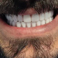 دندان مصنوعی|خدمات آرایشگری و زیبایی|قرچک, محمد آباد|دیوار