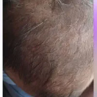 احیا مجدد مو