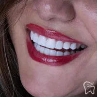 ونیر کامپوزیت لمینیت بلیچینگ دندان روکش اقسا*طی|خدمات آرایشگری و زیبایی|مشهد, راهنمایی|دیوار