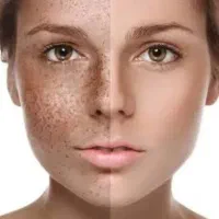 تمام جوش های کبدی صدرصد از بین میرن