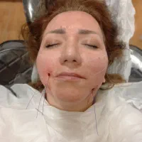 لیفت با نخ و جوانسازی