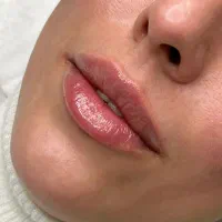 تخفیف ژل لب و بوتاکس فیلر مزو دکتر کاظمی