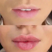 تزریق ژل و بوتاکس|خدمات آرایشگری و زیبایی|کرج, گلشهر|دیوار