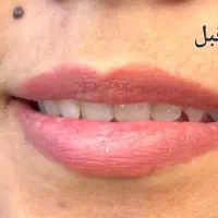 جشنواره لیزر موهای زاید بالای ۶۰٪تخفیف فیلر اقساطی|خدمات آرایشگری و زیبایی|کرمان, |دیوار