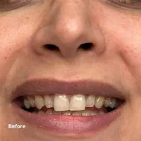 /کامپوزیت /لمینت / دنتال الماس|خدمات زیبایی و سلامت|کرج, کمال‌شهر|دیوار