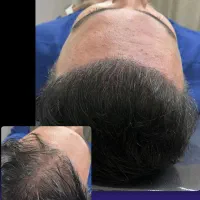 میکرواسکالپ اسکراپ کاشتمو درمجموعه زیبانو|خدمات آرایشگری و زیبایی|مشهد, گوهرشاد|دیوار