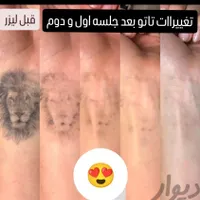 کلینیک تخصصی پاک کردن تتو با لیزر تضمینی/ریمو ابرو