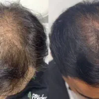 ژل فیلر بوتاکس مزو هایفو لیزر نخ|خدمات آرایشگری و زیبایی|اسلام‌شهر, باغ فیض|دیوار