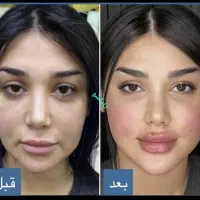 ساکشن غبغب شکم پهلو|خدمات آرایشگری و زیبایی|شیراز, عفیف‌آباد|دیوار