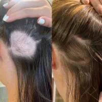 درمان کمپشتی  و رویش مو و ریش