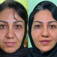 بوتاکس هیمو