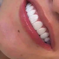مدل کامپوزیت زیر نظر پزشک در کلینیک دندانپزشکی|خدمات آرایشگری و زیبایی|اهواز, کیانپارس |دیوار