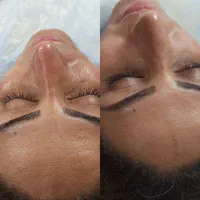 فشیال تخصصی و vip اسید تراپی کربوکسی