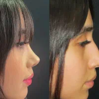 جراحی بینی،با دستگاه پیزوسرجری ،تخفیف 50درصد