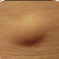 جراحی های ختنه ناخن لیپوم خال میخچه بخیه نوار قلب|خدمات آرایشگری و زیبایی|مشهد, الهیه|دیوار