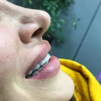 کامپوزیت دندان تخفیف ویژه روکش دندانپزشکی تهرانسر|خدمات آرایشگری و زیبایی|تهران, تهرانسر مرکزی|دیوار