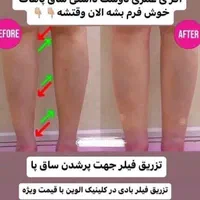 فیلر لب زیر چشم فیلر بادی نخ لیفت پی ار پی مزو|خدمات آرایشگری و زیبایی|اصفهان, سیچان|دیوار