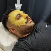 خال برداری درمان کک و مک فشیال درمطب.بانوان-اقایان