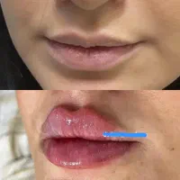 فیلر لب فیلر صورت