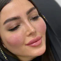 آموزش و تزریق ژل بوتاکس پی ار پی پی ار اف اگزوزوم|خدمات آرایشگری و زیبایی|اهواز, کیانپارس |دیوار