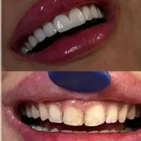 کامپوزیت دندان اقساط با چک((حتی بدون پیش پرداخت))
