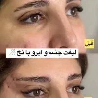 فیلر لیفت بینی و صورت وشقیقه مزوتراپی بوتاکس|خدمات آرایشگری و زیبایی|تهران, تهرانپارس جنوبی|دیوار
