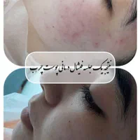 ارائه خدمات فیشال  و پاکسازی صورت با بهترین متریال|خدمات آرایشگری و زیبایی|مشهد, عبادی|دیوار
