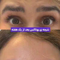 جشنواره ۵۰٪  بوتاکس فول فیس - برج ماندگار عظیمیه|خدمات آرایشگری و زیبایی|کرج, عظیمیه|دیوار