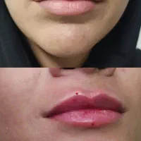 ژل، فیلر لب ۵۰۰،آنزیم ۳۵۰،زاویه ،بوتاکس۴۵۰|خدمات آرایشگری و زیبایی|قم, تولید دارو و یخچال|دیوار