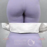 آف ۵۰٪ فیلر بادی هیپ دیپ سینه بیکینی باسن دست پا|خدمات آرایشگری و زیبایی|مشهد, نیروی هوایی|دیوار