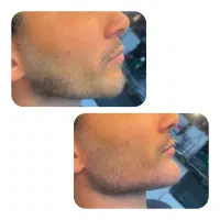 زاویه سازی صورت (فیلر چانه، زاویه سازی، گونه و لب)