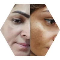 انواع فیشال و پاکسازی پوست در حوزه زیبایی|خدمات آرایشگری و زیبایی|لاهیجان, انقلاب|دیوار