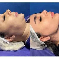 جشنواره نوروزی ساکشن و بلفاروپلاستی