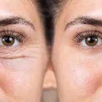 درمان قطعی چروک معرفی شده در شبکه سه سیما