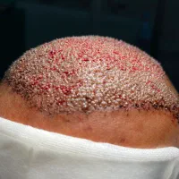 جذب و استخدام کاشت مو