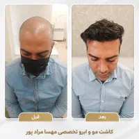 کاشت مو و ابرو تضمینی  با شرایط ویژه اقساط