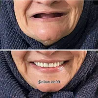 دندانسازی دندان مصنوعی تحویل ۲روزه باضمانت