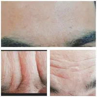 ژل و بوتاکس|خدمات آرایشگری و زیبایی|بجنورد, |دیوار