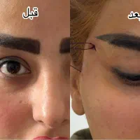 تزریق ژل و بوتاکس-چربی|خدمات آرایشگری و زیبایی|اهواز, کیانپارس |دیوار