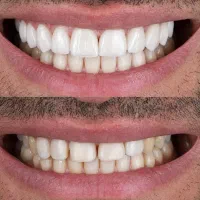بیمار زیبایی لمینیت برای دوره دندانپزشکی|خدمات زیبایی و سلامت|تهران, امانیه|دیوار