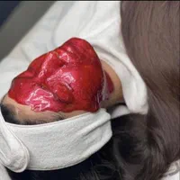 تخفیف پدیکورپا پاکسازی فیشال تخصصی پلاژن تراپی مزو